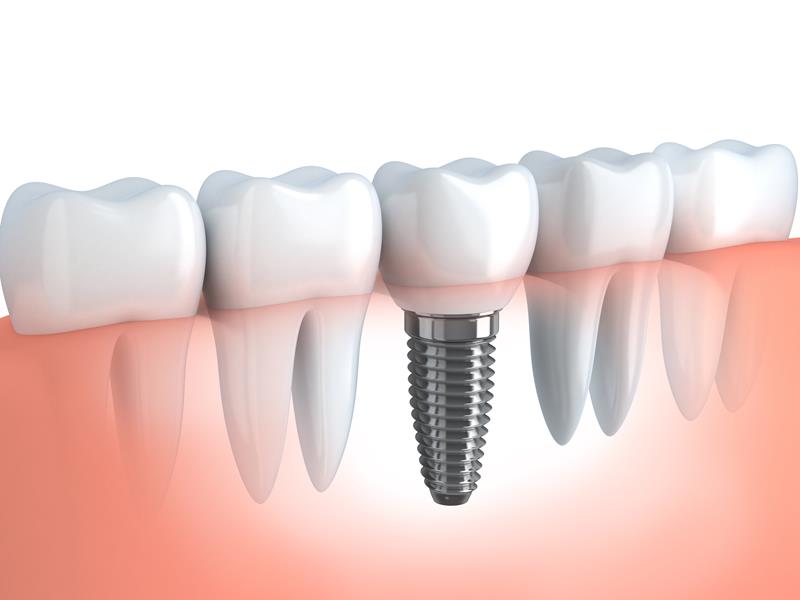 Dental Implants  Bay Shore, NY 